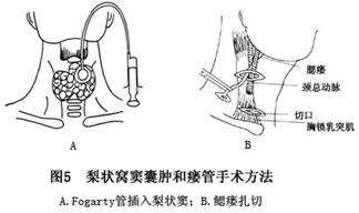 梨状窝瘘的手术方式.jpg