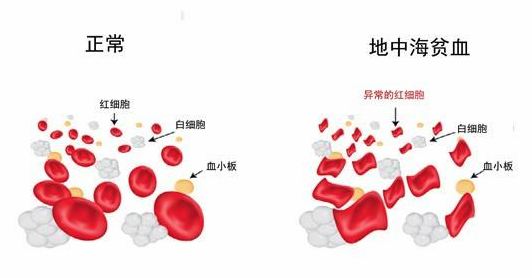 Mitapivat有望成为首个非输血依赖型地中海贫血的口服疗法_香港济民药业